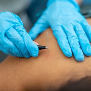 Closeup shot of a doctor connecting an acupuncture needle with the cable